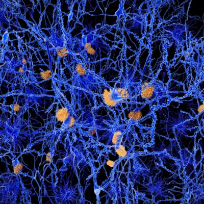 Amyloid plaques in Alzheimer's disease